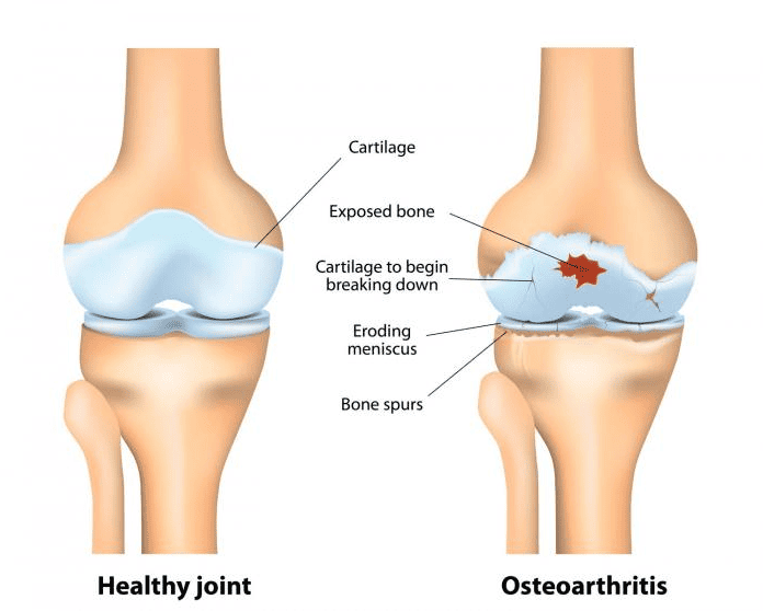 Arthritis