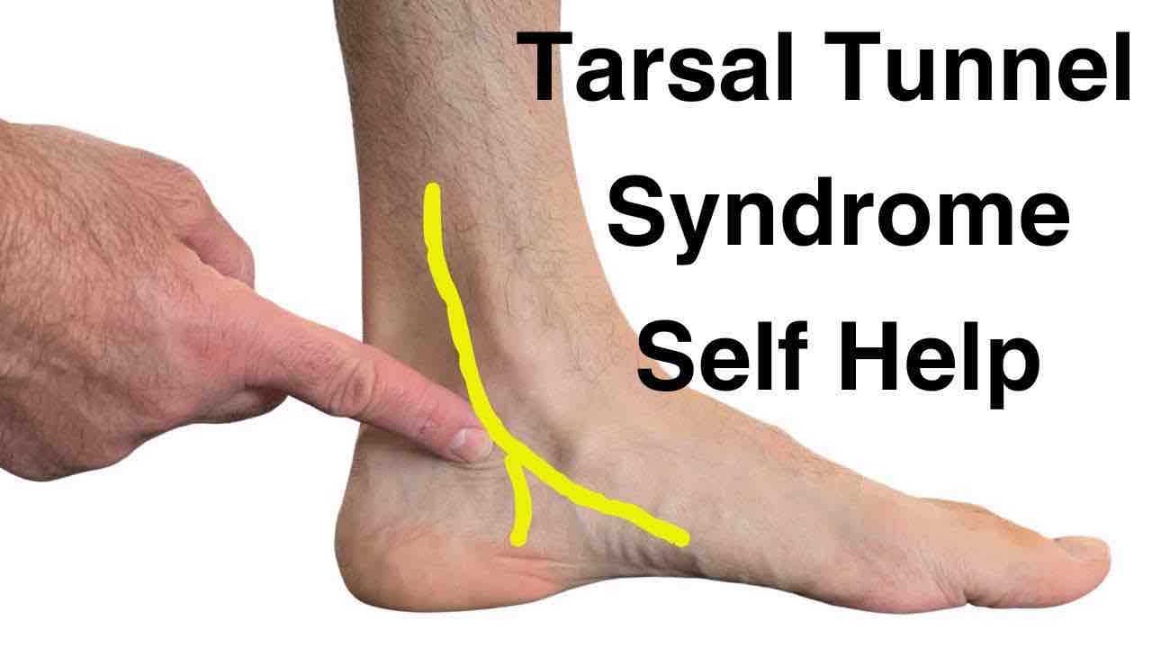 Tarsal Tunnel Syndrome (TTS) 