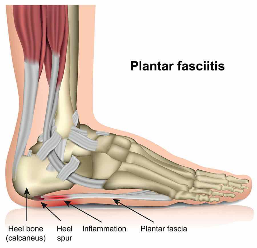 Plantar Fasciitis treatment in Richmond Hill