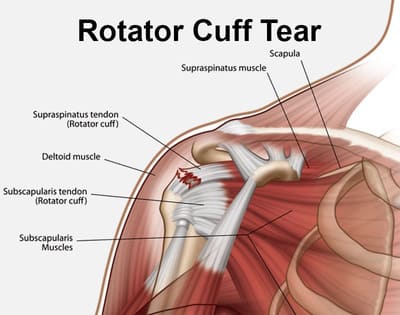 Rotator Cuff Injury