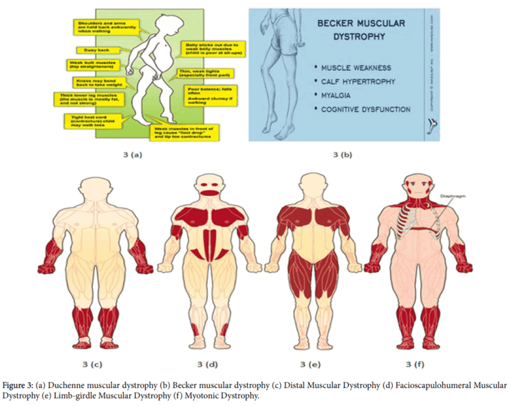 Muscular dystrophy