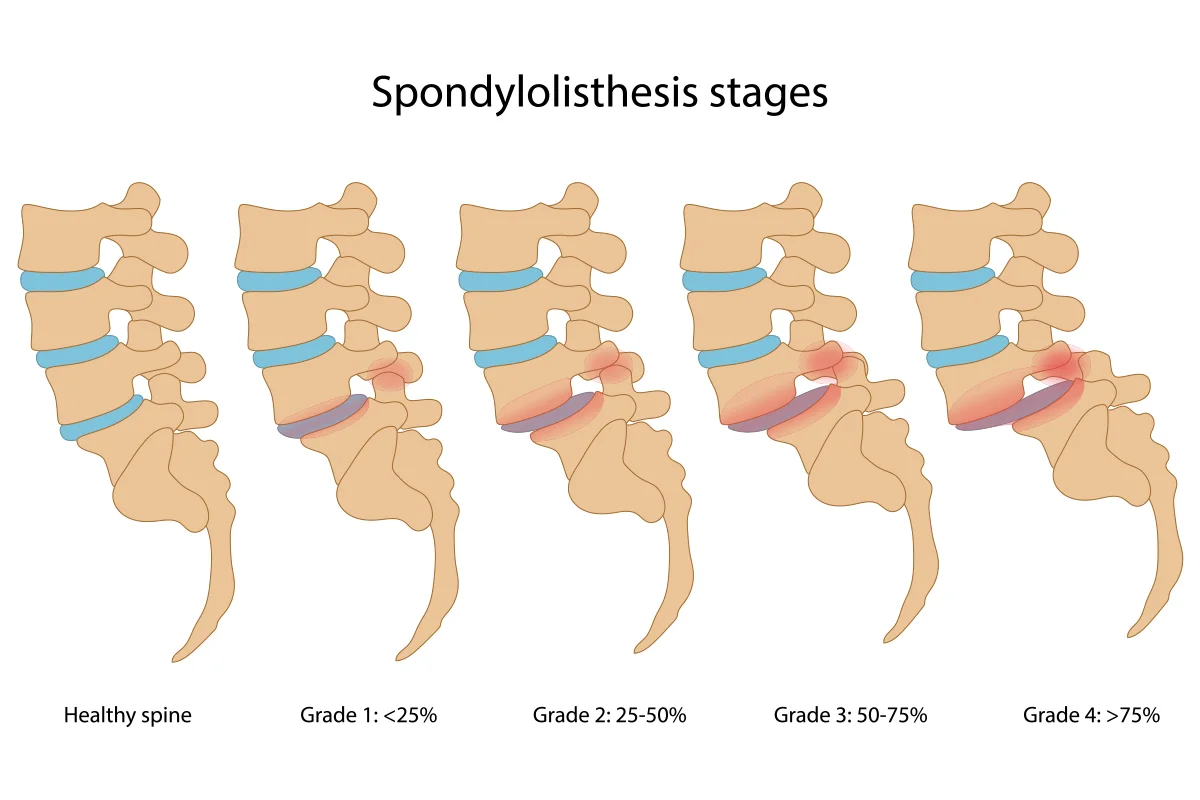 Spondylolisthesis