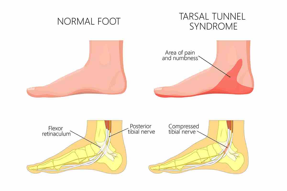 TTS Syndrome