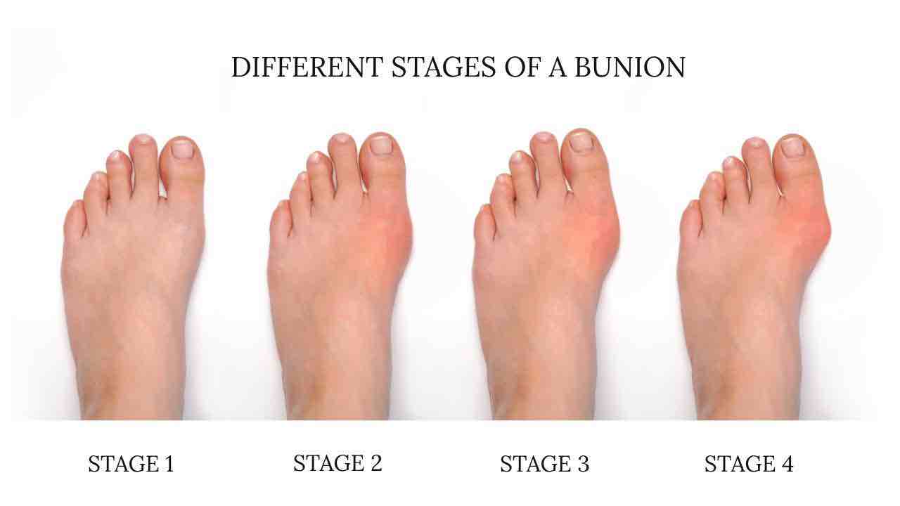 Bunion Foot 