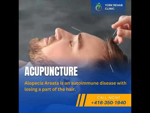 Alopecia Areata treatment with acupuncture